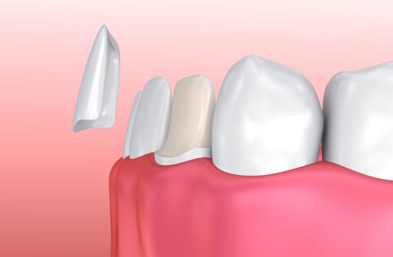 not Reductor lime Estetica dentara | Fatetare dentara | Fatete ceramica E-MAX | Pret fatete  dentare | Cabinet stomatologic fatete dentare | Houston Dental Clinic
