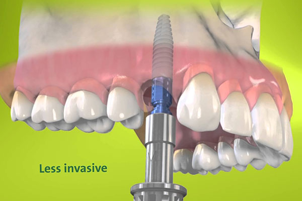 IMPLANT STRAUMANN ROXOLID
