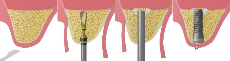 chirurgie dentara